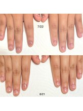 リンク(LINK)/深爪