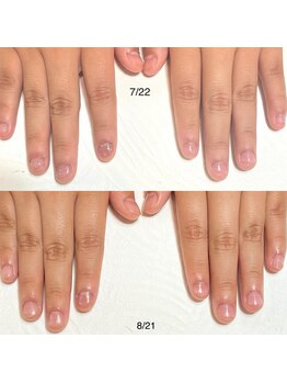 リンク(LINK)/深爪