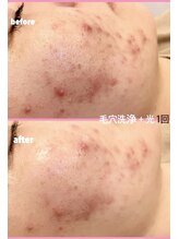 ミレボ(Me.rebo)/毛穴洗浄＋光1回の症例写真