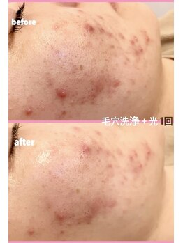 ミレボ(Me.rebo)/毛穴洗浄＋光1回の症例写真