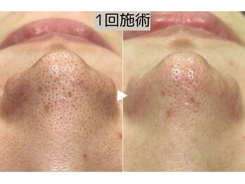 ロワ(Roi)/【毛穴洗浄+顔脱毛】1回施術