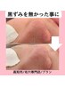【毛穴汚れ・黒ずみ・ざらつき除去】毛穴引き締めケアも！　80分￥13,000→