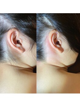 ヴァージンワックス 六本木店(Virgin Wax)/【うなじ】ビフォーアフター