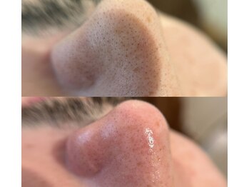 サロンドポノ(Salon de Pono)/韓国式3d毛穴洗浄