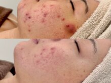 ニコレ(Nicore)/赤み/ニキビケア/３回目