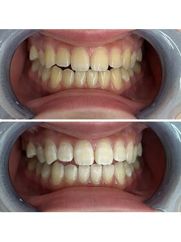 グリッター ショウナン(glitter. SHONAN)/歯のホワイトニングbefore/after