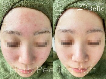 【毛穴｜ハーブピーリング】韓国肌管理Belle 新橋/ハーブピーリング｜ニキビケア