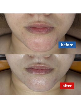 サロン ド メタセコイア(salon de Metasequoia)/【タラソ】before／after