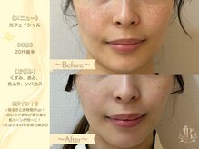 リリーベル 新宿歌舞伎町(Lily Belle)の雰囲気（光フェイシャル/シミ/跡/赤み/くすみ/色ムラ改善）