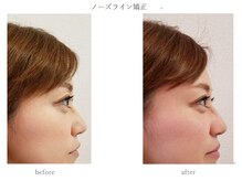 プラナ(PRANA)/ノーズライン矯正　before/after