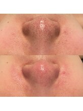 ミューズ(MUSE)/エクストラクション＋美顔フォト