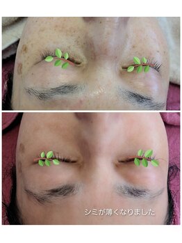 エタニティ(Eternity)/しみケアーお任せください!