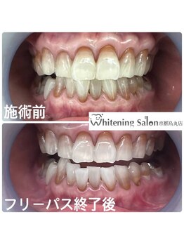 ホワイトニングサロン 京都烏丸店/ホワイトニング施術例