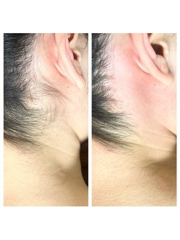 ヴァージンワックス 六本木店(Virgin Wax)/【うなじ】ビフォーアフター