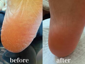 ドクターネイル爪革命 札幌本店/症例紹介31 角質ケア