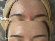 ホワイトアクア 北千住店(WHITE AQUA)/ハーブピーリング4回/ニキビケア