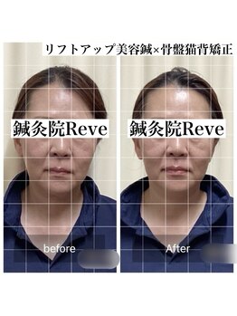 わきさか鍼灸整骨院・鍼灸院 レーヴ(Reve)/before after