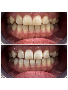 グリッター ショウナン(glitter. SHONAN)/藤沢ホワイトニングbefore/after