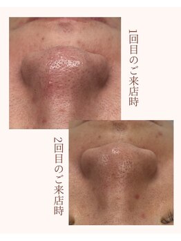 レア(Lea)/黒ずみ激減!毛穴も小さくなる！