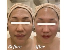 シェリール(Cherir)/ACトリートメント