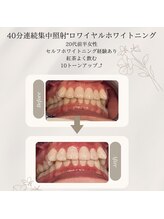 プラスビーセルフ(+b self)/ホワイトニングビフォーアフター