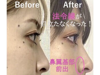 ラプリアンジュ 鹿児島天文館店(Raplit ange)/隆鼻+輪郭矯正40分10回