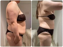 イデアルミー 大宮店(イデアルMe)/痩身エステ3ヶ月間Before　After