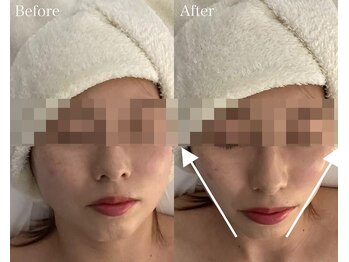 ベル 後楽園 春日(Belle)/小顔/リフトアップ/二重顎