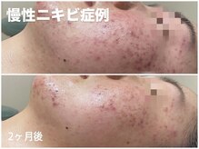 ソフ(soph.)/慢性ニキビ症例