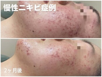 ソフ(soph.)/慢性ニキビ症例