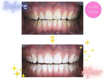 エクシアホワイトニング 京都駅前店/ホワイトニングビフォーアフター