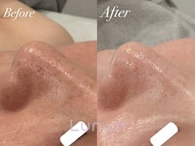 ルノン(Lunon)/毛穴洗浄ハイドロ×ララピール