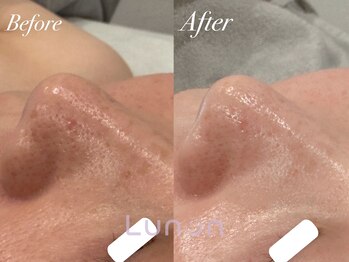 ルノン(Lunon)/毛穴洗浄ハイドロ×ララピール