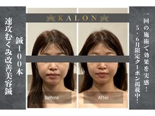 カロン(KALON)の雰囲気（むくみ顔を美容鍼で深部から根本アプローチ）