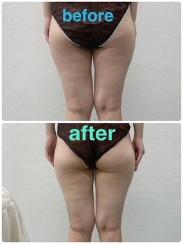 ハロ 南青山(HALO)/【脂肪分解スタンプ】太もも