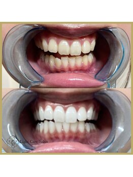 ライトケアサロン 銀座店(Light Care Salon)/セルフホワイトニングの症例写真