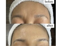 ビビ イーストフィールド 天白 名古屋(vivi)/美肌フォトRF