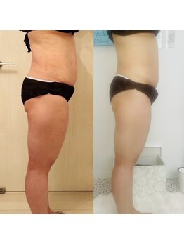 メゾン アンジュ(Maison Ange)/痩身コース/before&after