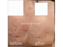 リノサロン モアナ(lino salon moana)の雰囲気（ダイヤモンドピーリング&美容液導入,ニキビケア素肌美人/￥6,800）