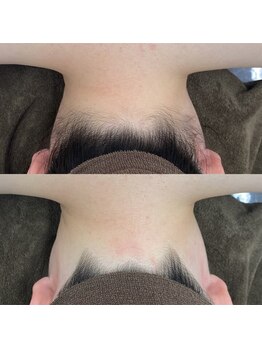 ミース 福岡本店/うなじ矯正◆ビフォーアフター