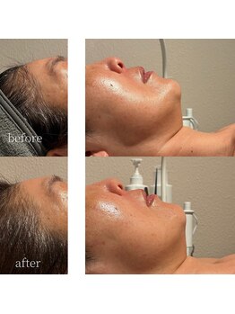 コモレビ(komorebi)/町田駅/フェイスワックス/顔脱毛