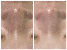 エクラニーク(Eclanique)/お鼻の黒ずみ！