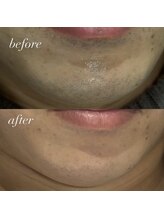 エースビューティー(Ace.Beauty)/ヒゲ脱毛