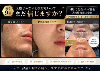 モデルズ 名古屋(MODELS)の写真/全国から問い合わせ多数ヒゲ脱毛が初回３３００円。清潔感ある毎日をサポート◎