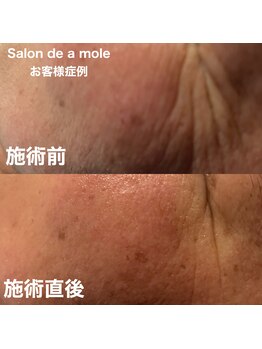 サロンドアモール(Salon de a mole)/ハーバルシー症例写真/シミ/シワ