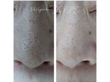 ドブレ(DOBRE)/【プラズマフェイシャル】