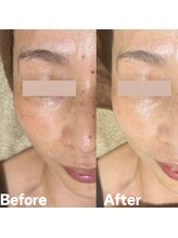 サロン ド エン(Salon de. en)/しみケア◇ハーブピーリング