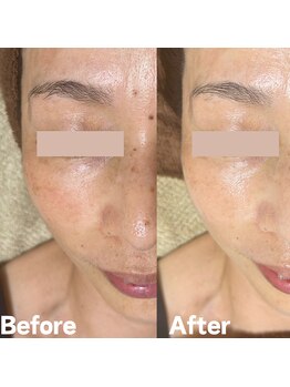 サロン ド エン(Salon de. en)/しみケア◇ハーブピーリング