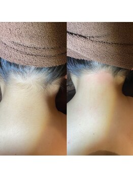 ヴァージンワックス 六本木店(Virgin Wax)/【うなじ】ビフォーアフター