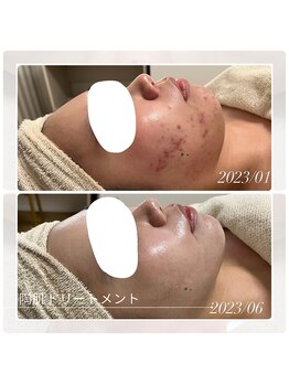 アチェリー(aCherry)/陶肌トリートメント